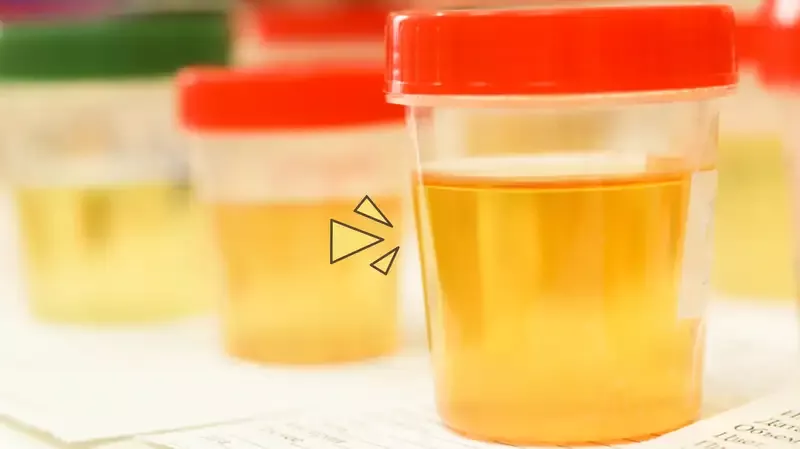 Inilah Warna Urine Normal dan Sehat, Kenali Juga Ciri-Ciri yang Perlu Diwaspadai