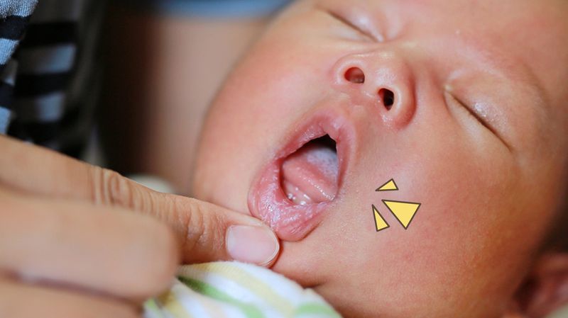 Sariawan pada Bayi: Gejala, Penyebab, dan 14 Tips Mengatasinya