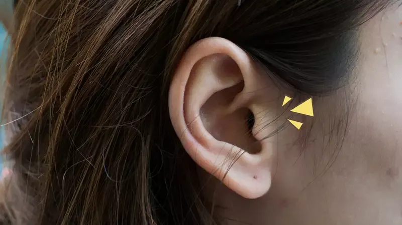 5 Cara Mengatasi Jerawat Membandel di Telinga