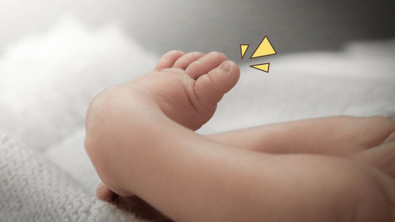 Clubfoot, Kondisi Kaki Bayi Bengkok dengan Jari-Jari yang Tampak Melengkung