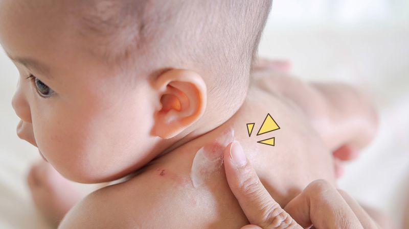 9 Penyakit Kulit pada Bayi dan Cara Mengatasinya, Cari Tahu Yuk Moms!