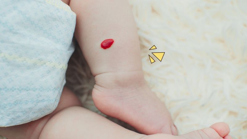 Mengenal Hemangioma, Tumor Jinak pada Bayi yang Bisa Ganggu Pernapasan