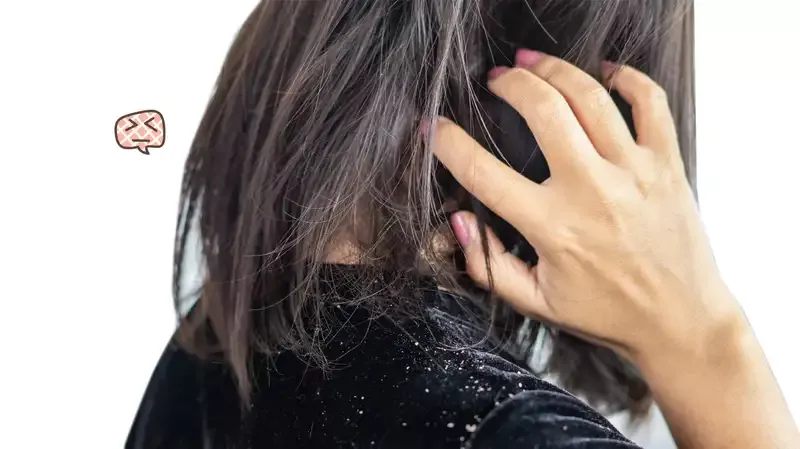 5 Cara Mencegah Ketombe Agar Rambut Tetap Bersih