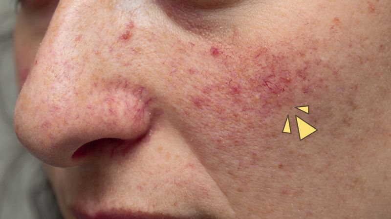 Penyakit Rosacea, Keadaan Kulit Kronis Yang Sebabkan Wajah Memerah | Orami