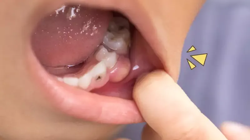 obat sakit gigi gusi bengkak pada anak 12
