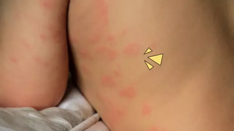 5 Tanda Bayi Alergi. Jangan Disepelekan Ya, Moms!