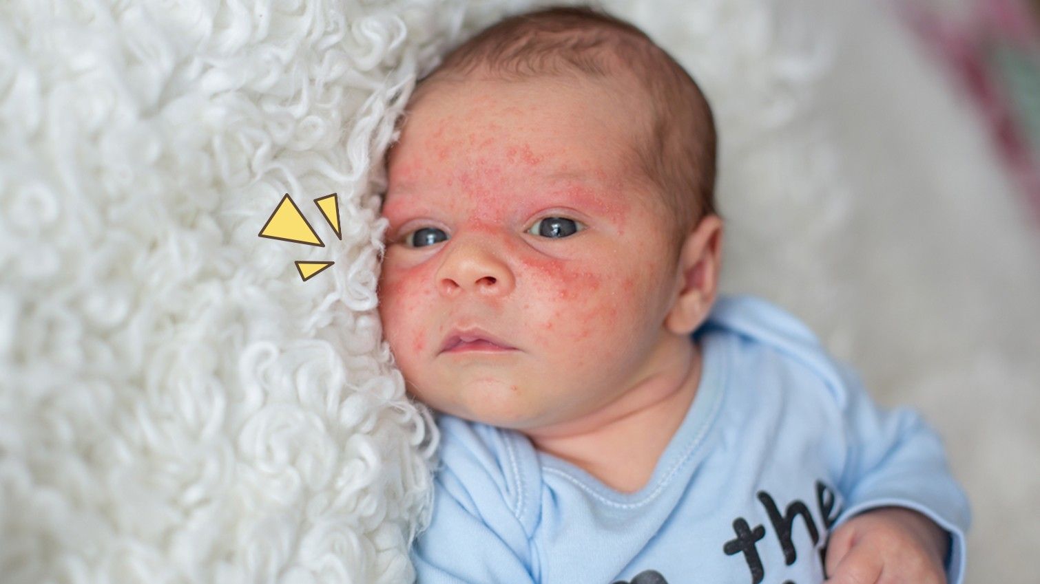 Yuk, Ketahui Cara Tepat Merawat Kulit Bayi dengan Dermatitis Atopik
