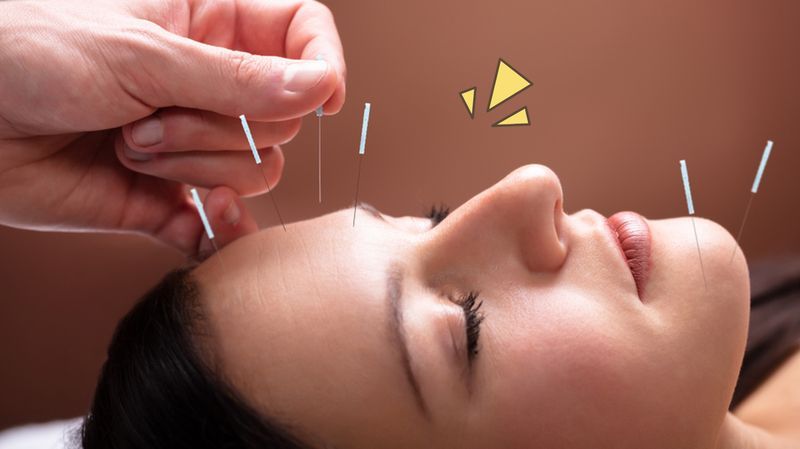 Mengenal Akupunktur Wajah, Bisa Melancarkan Sirkulasi Darah dan Membuat Kulit Jadi Elastis!