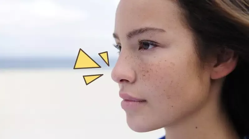 Apa Itu Freckles di Wajah dan Kenapa Bisa Timbul?