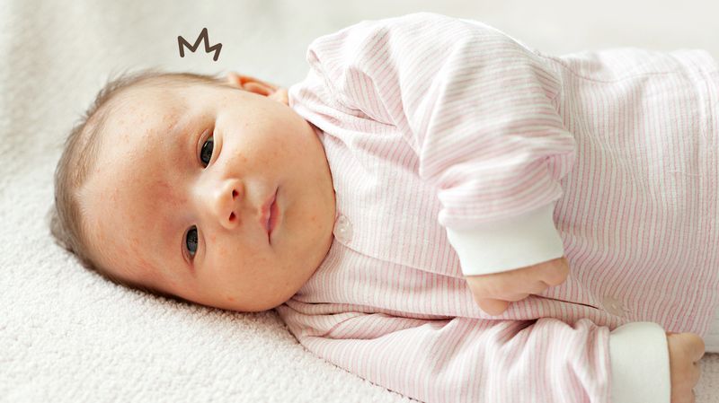 8 Penyebab Bercak Putih pada Wajah Bayi, Seberapa Berbahaya? Begini Cara Mengatasinya