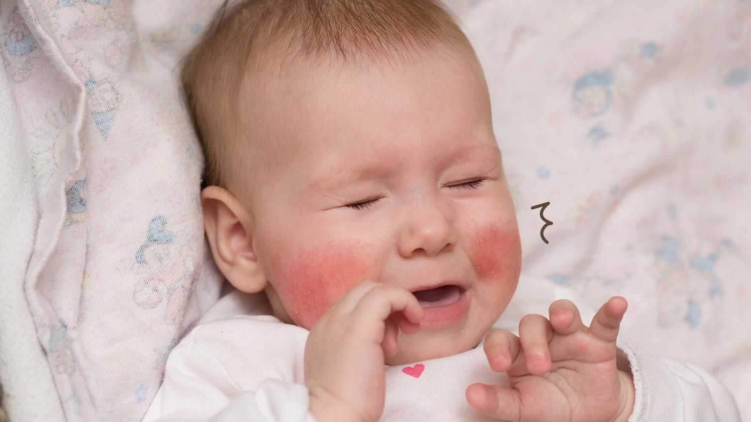 Patut untuk Diikuti, Ini 5 Cara Mengetahui Risiko Alergi pada Bayi