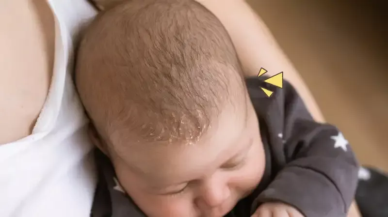 4 Cara Alami Mengatasi Cradle Cap pada Bayi