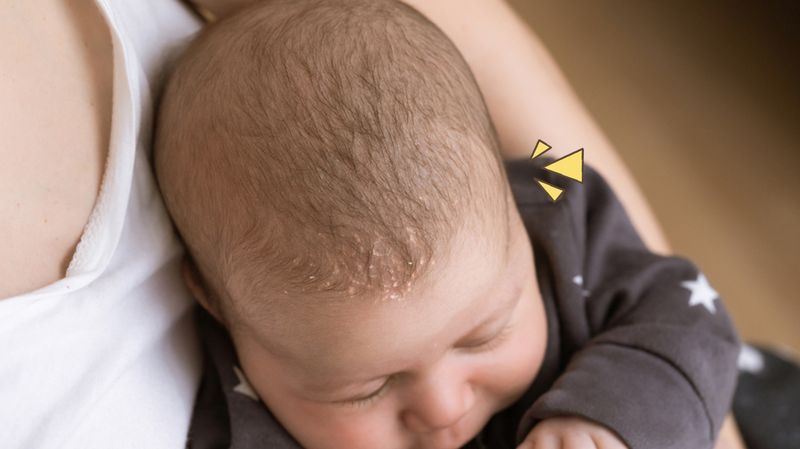 4 Cara Alami Mengatasi Cradle Cap pada Bayi
