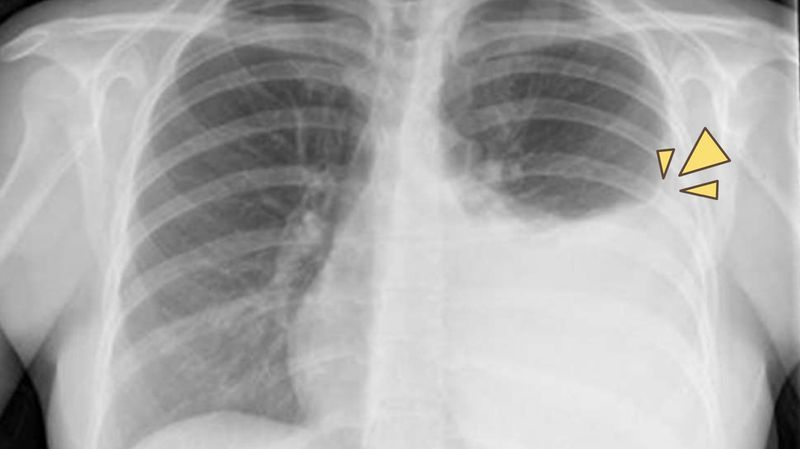 Efusi Pleura, Penumpukan Cairan di Antara Jaringan yang Melapisi Paru-paru dan Dada