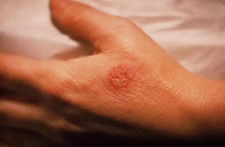Mengenal Nummular Dermatitis, Peradangan Kulit Berbentuk seperti Koin