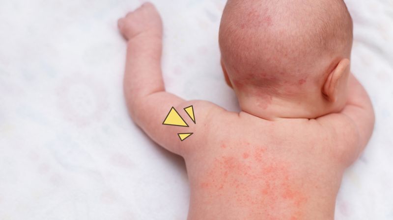 Ruam Amoxicillin pada Bayi, Kondisi Ruam karena Antibiotik