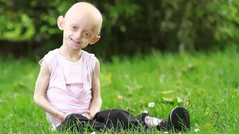 Mengenal Progeria, Penyakit Langka yang Bikin Si Kecil Bertubuh Lansia