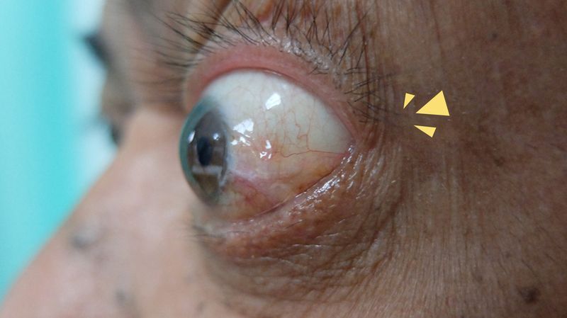 Mengenal Proptosis, Benjolan Tidak Normal pada Bola Mata
