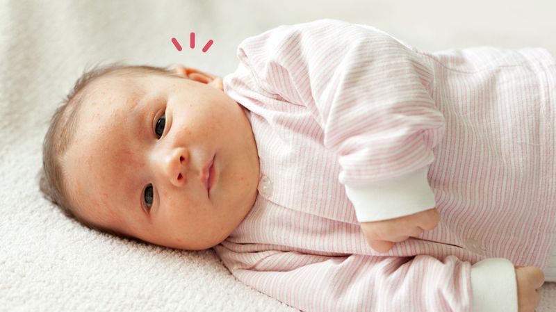 11 Jenis Ruam Pada Bayi serta Cara Mengatasinya, Moms Perlu  Tahu, Nih!