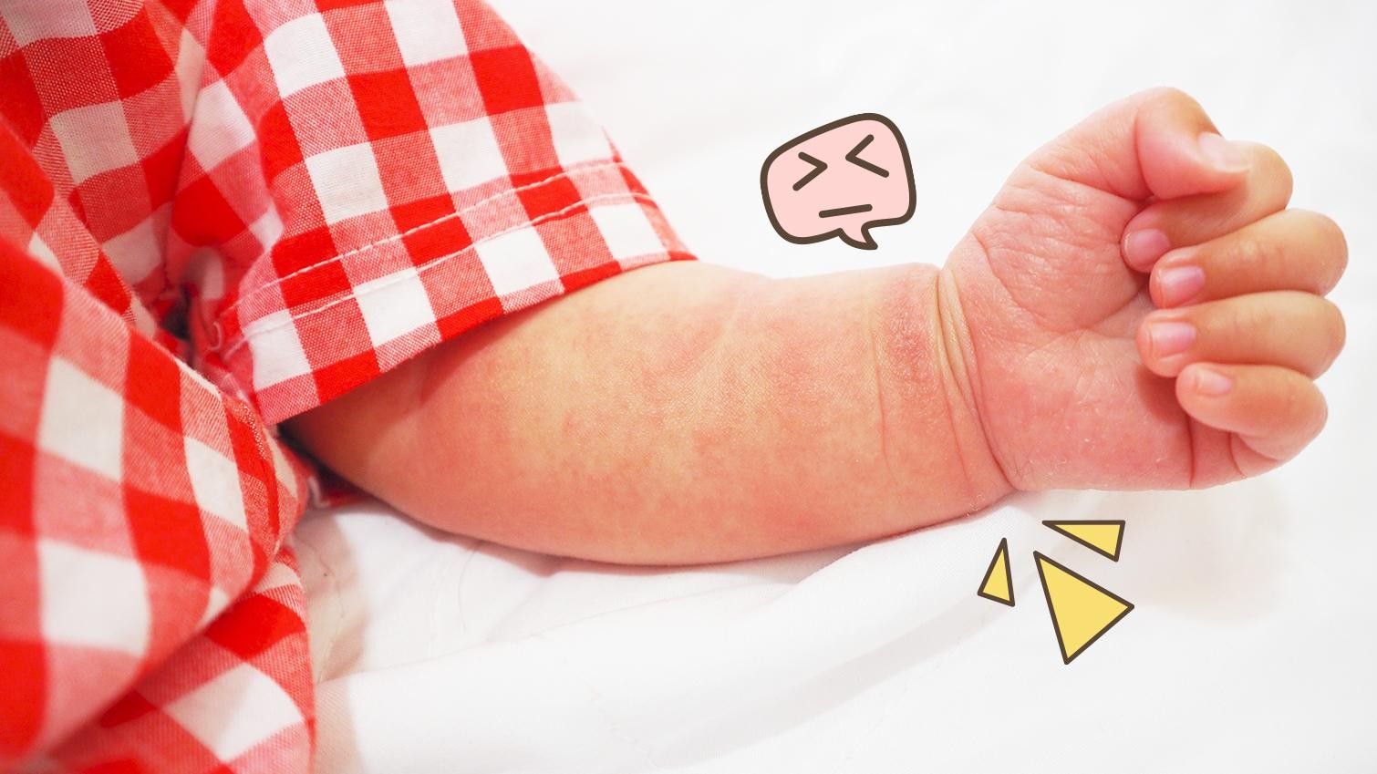 Waspada Flu Singapura Pada Bayi, Begini Cara Mencegah Penularannya